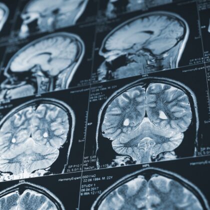 Traumatic brain injury